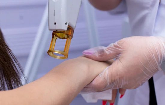 Laser and aesthetic treatment