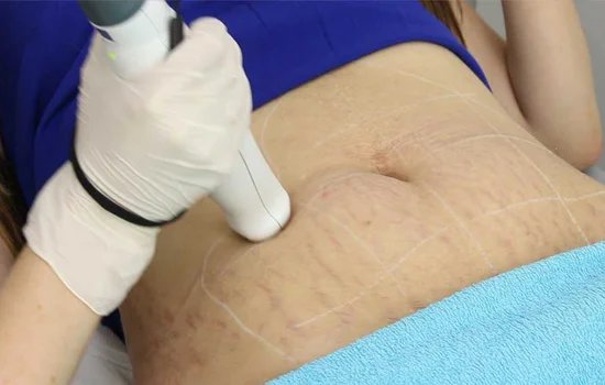 Stretch Mark Removal