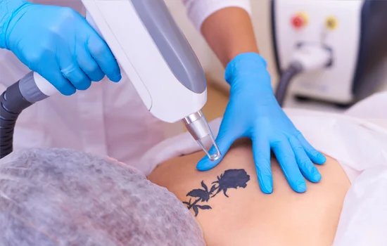 Tattoo Removal Treatment